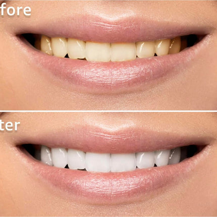 Smiletruly 2 PACK Teeth Whitening Pen No Sensitive Gel for a Beautiful White Smile